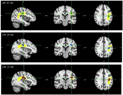 Changes in the superior longitudinal fasciculus and anterior thalamic radiation in the left brain are associated with developmental dyscalculia